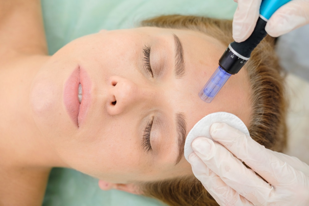 Discover the Benefits of Microneedling