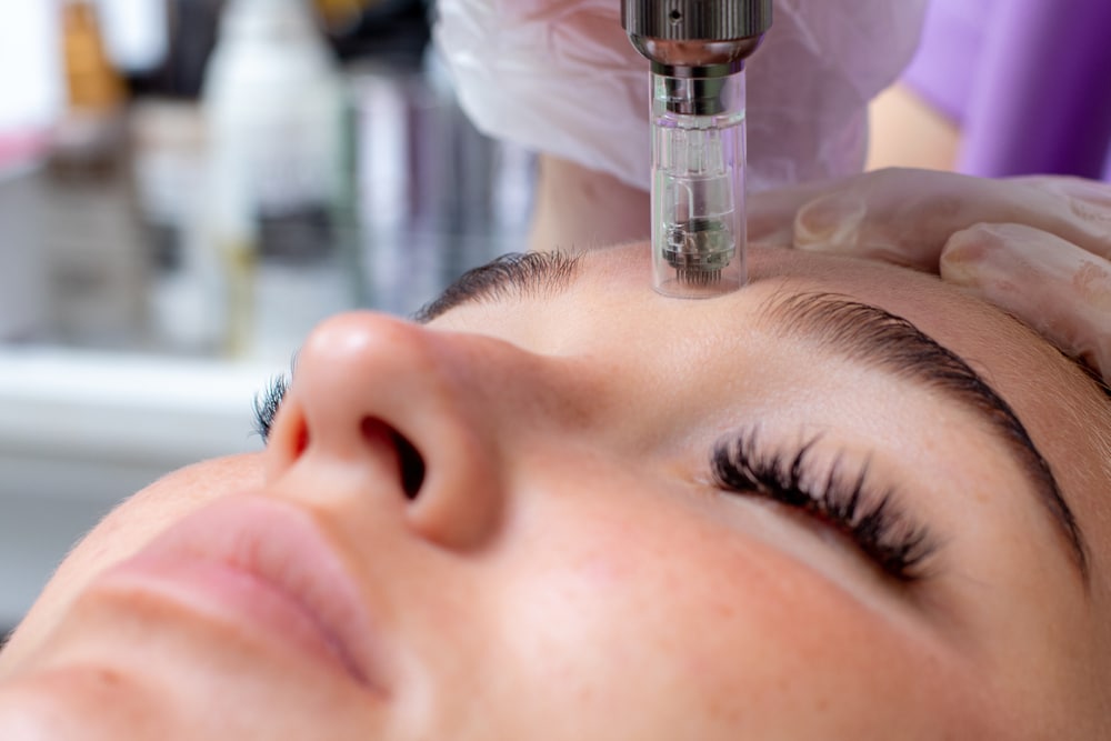 Are you tired of dealing with skin imperfections like acne scars or dullness? If so, you may be interested in exploring the wonders of microneedling treatment. At Aesthetic Essentials in Willoughby Hills, OH, we specialize in providing cutting-edge beauty solutions, including microneedling services. Let us take a comprehensive dive into the world of microneedling, unraveling the mysteries behind this revolutionary treatment. Join us as we explore what microneedling is, its remarkable benefits, and how it works to give you the radiant, rejuvenated skin you desire. What Is Microneedling? Microneedling, also known as collagen induction therapy, is a minimally invasive treatment that involves using a derma roller or a pen-like device with tiny needles to create microchannels on the skin's surface. These microchannels stimulate the skin's natural healing response, triggering collagen and elastin production — the building blocks of healthy, youthful skin. By enhancing the skin's regenerative capabilities, microneedling helps to improve texture, reduce fine lines and wrinkles, and minimize the appearance of scars and hyperpigmentation. How Does Microneedling Work? Microneedling works its magic by harnessing the body's innate healing abilities. The tiny needles create microchannels on the skin's surface, triggering a cascade of reactions. The body perceives these micro-injuries as an opportunity to repair and regenerate the skin. As a result, collagen and elastin production is stimulated, leading to a firmer, smoother, and more radiant complexion. But how does this process unfold? Let's break it down step by step: Preparation To ensure your comfort during the microneedling treatment, a topical numbing cream will be applied before the procedure starts. Microchannel Creation We gently move the derma roller or pen-like device over the treatment area. The tiny needles create controlled microchannels, which are virtually invisible to the naked eye. Stimulating Collagen Production The microchannels act as communication channels, signaling the skin to increase collagen and elastin production. This natural response revitalizes the skin from within, resulting in a more youthful appearance. Enhanced Absorption of Skincare Products The microchannels created during microneedling also enhance the absorption of skincare products. Any serums or creams applied immediately after the treatment can penetrate deeper into the skin, maximizing their effectiveness. Rejuvenation and Healing Following the microneedling session, the skin enters a phase of rejuvenation and healing. Over the next few weeks, you may notice improvements in skin texture, a reduction in fine lines and wrinkles, and a more even skin tone. What Are the Benefits of Microneedling? Microneedling offers a plethora of benefits that make it an attractive option for individuals seeking skin rejuvenation. Here are some critical advantages of microneedling: Can Be Used on Multiple Parts of the Body While the face is the most common area for microneedling, the procedure can also be used on other body parts to improve skin quality or reduce the appearance of scars or stretch marks. Enhanced Absorption of Skincare Products The microchannels created during microneedling allow skincare products to penetrate deeper into the skin, maximizing their efficacy and delivering better results. Non-Invasive and Minimal Downtime Unlike more invasive procedures, microneedling is minimally invasive, requiring little to no downtime. You can typically resume your regular activities shortly after the treatment. What Do We Use for Microneedling Treatments? We offer a range of microneedling treatments and services that can completely customize your experience. Using our RejuvaPen for microneedling, we can adjust the depth of the needles we use and apply a serum that best benefits your skin. In addition to our standard microneedling with PRP, we also provide add-ons such as the Derma Peel. This topical solution uses a combination of acids to eliminate the top layer of your skin, revealing fresher, healthier cells and a more uniform complexion. We offer proprietary boosters that we can apply after the Derma Peel for even more intense results. Our team is dedicated to making your microneedling experience as personalized and effective as possible. How Often Should You Schedule Your Microneedling Treatments? The remarkable results achieved with microneedling are a testament to its effectiveness. While individual experiences may vary, many clients report noticeable improvements in their skin's appearance and texture after a series of microneedling sessions. It is generally recommended to undergo multiple treatments spaced several weeks apart to achieve optimal results. This allows the skin ample time to heal and regenerate between sessions. What Qualifies You for Microneedling Treatments? Microneedling is a non-invasive treatment that helps improve the appearance of fine lines, wrinkles, and scars by stimulating your skin's natural healing process. However, not everyone may be a suitable candidate for this treatment. Factors such as skin type, health conditions, and medications can affect your eligibility for microneedling services. To determine whether microneedling is right for you, you must schedule a consultation with our expert staff. During the consultation, we will evaluate your skin and discuss your goals before creating a personalized treatment plan tailored to your needs. We aim to ensure you receive the best microneedling treatments possible to help enhance your skin's appearance. Unlock Your Skin's Potential With Microneedling in Willoughby Hills, OH Unleash your skin's potential and achieve your skincare goals with the safe and effective microneedling treatments offered at Aesthetic Essentials in Willoughby Hills, OH. Say goodbye to fine lines, wrinkles, acne scars, and hyperpigmentation, and welcome a more radiant version of yourself. Our microneedling services provide a non-invasive solution to a variety of skin concerns. Let our team help you discover the transformative power of microneedling with our expert guidance and personalized approach. Experience the radiance within you and schedule your consultation with us today. | Aesthetic Essentials